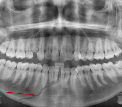 fratura raticular fratura raticular