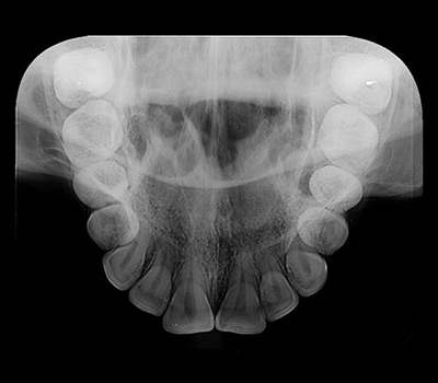 método oclusal método oclusal