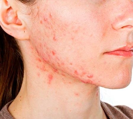 acne e rosácea acne e rosácea