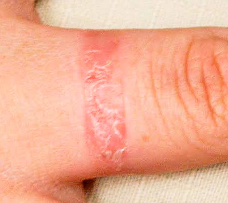 dermatite de contato dermatite de contato