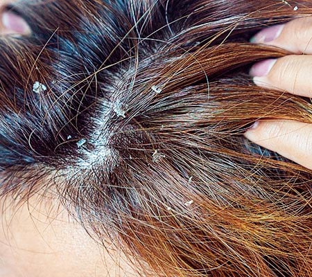 dermatite seborreica dermatite seborreica