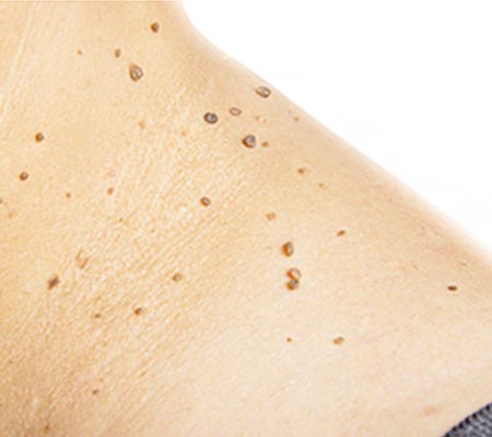 dermatoses bacterianas dermatoses bacterianas