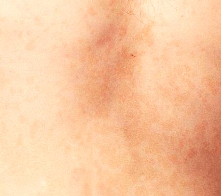dermatoses fúngicas dermatoses fúngicas