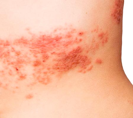 dermatoses parasitárias dermatoses parasitárias