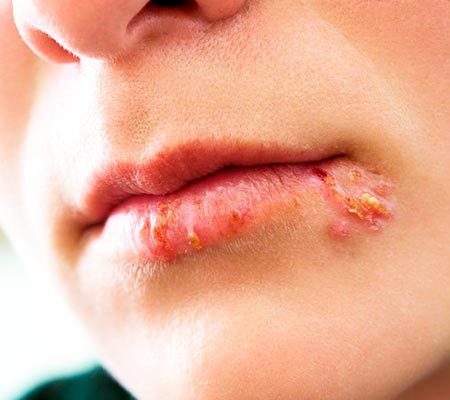 dermatoses virais dermatoses virais