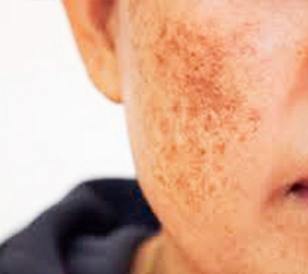 Melasma Melasma