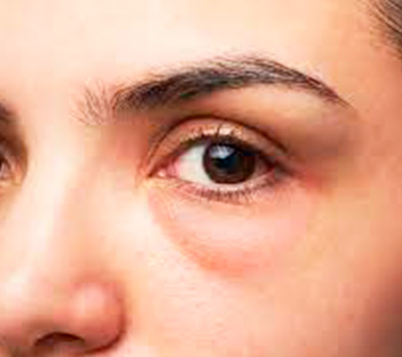 olheiras vascular, profunda e pigmentar olheiras vascular, profunda e pigmentar