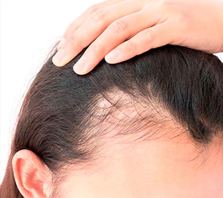 Melasma Melasma