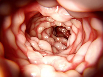 doença de Crohn doença de Crohn