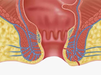 fístula anal e abscessos fístula anal e abscessos