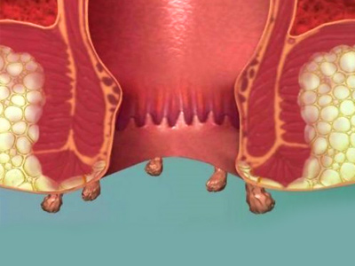 condiloma e verrugas anais condiloma e verrugas anais