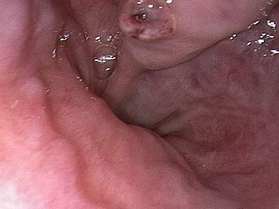 Ligadura de varizes esofágicas Ligadura de varizes esofágicas