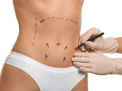 Abdominoplastia Abdominoplastia