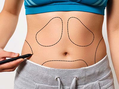 Lipoaspiração Lipoaspiração