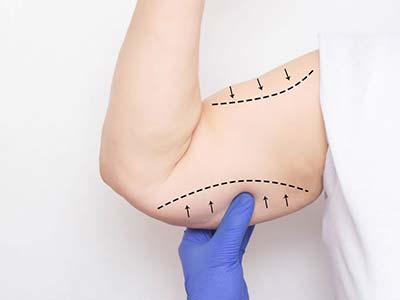 Puboplastia braquioplastia (braços) Puboplastia braquioplastia