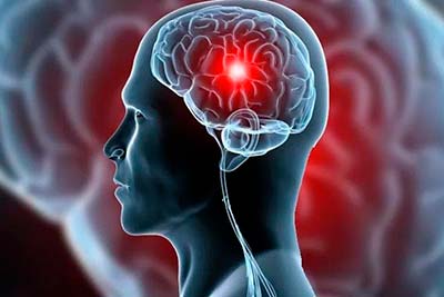 Acidente vascular cerebral AVC