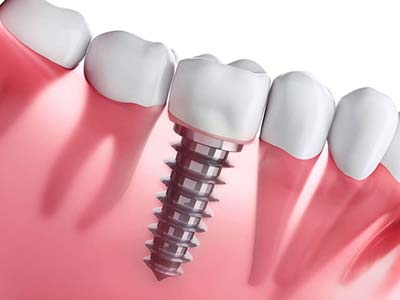 Implante dentário
