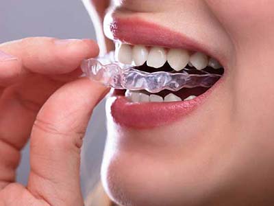 Alinhadores Invisíveis (Invisalign)