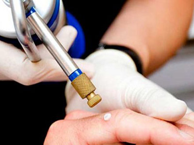 Cauterização e crioterapia Cauterização e crioterapia
