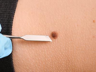 procedimentos dermatológicos procedimentos dermatológicos