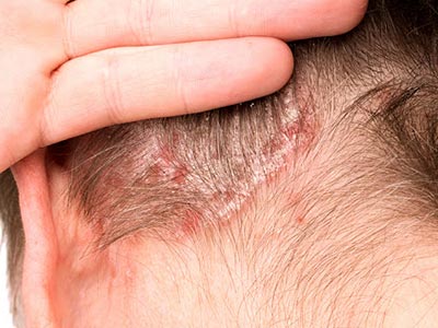 Alergias e dermatite seborreica Alergias e dermatite seborreica