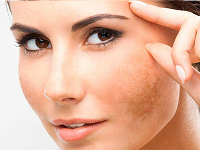 Melasma, psoríase e micoses Melasma, psoríase e micoses