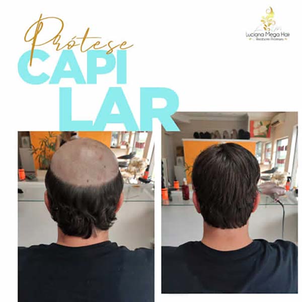 Prótese capilar Prótese capilar