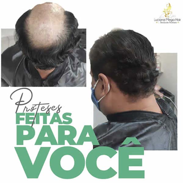 Prótese capilar Prótese capilar