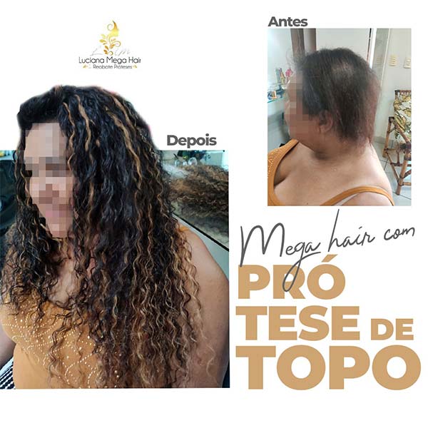 Prótese capilar Prótese capilar