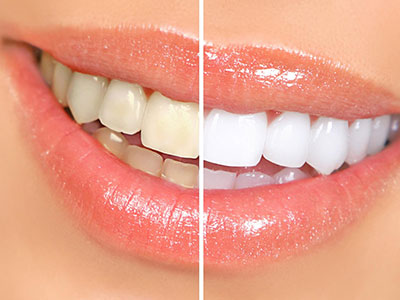 clareamento dental clareamento dental