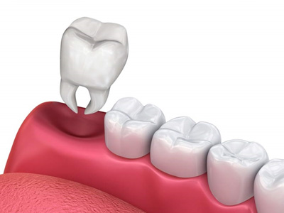 extração de dentes extração de dentes