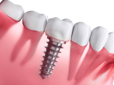 implantes implantes