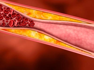 Doenças arteriais Doenças arteriais