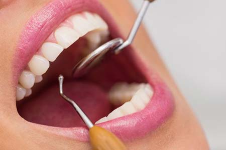 Reestauração dos dentes restauração dos dentes