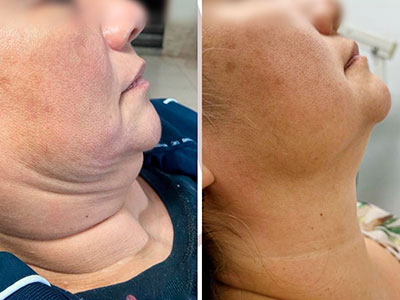 harmonização antes e depois harmonização antes e depois