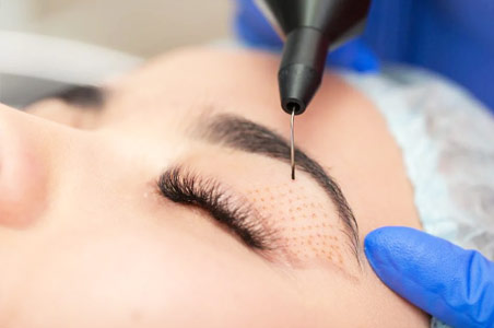 blefaroplastia blefaroplastia