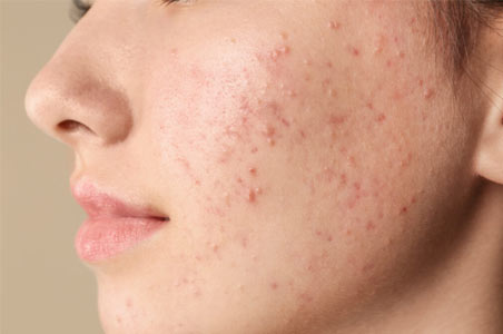 cicatriz de acne cicatriz de acne