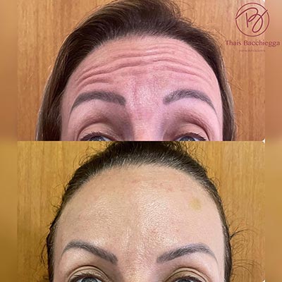 harmonização facial harmonização facial