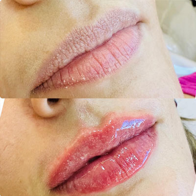 preenchimento labial preenchimento labial