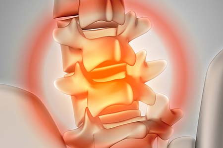 Fisioterapia para hérnia de disco tratar hérnia de disco com fisioterapia