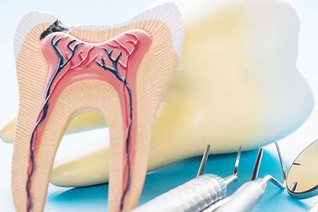 Tratamento de canal (endodontia) tratamento de canal