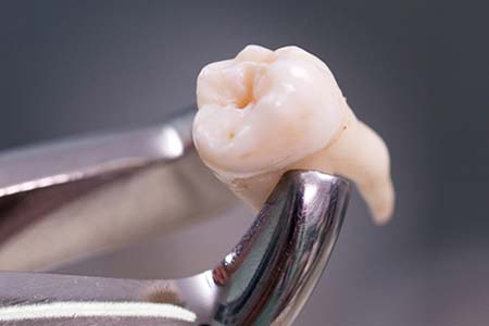 Extração de dentes extração de dentes