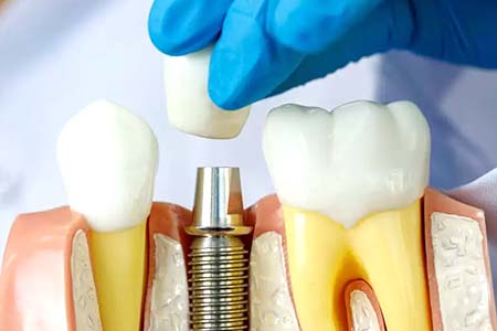 Implantes dentários implantes dentários