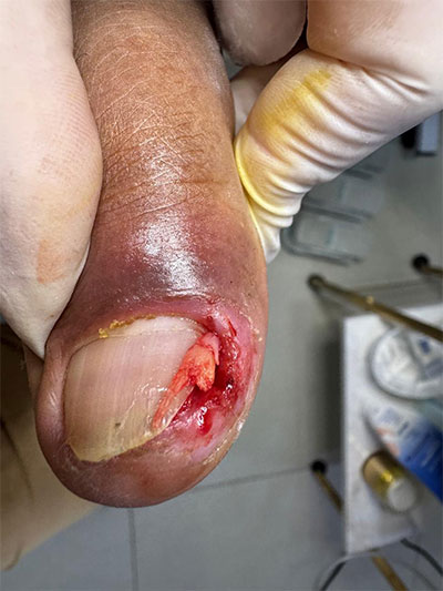 espiculectomia espiculectomia