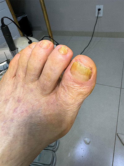 podo geriatria depois
