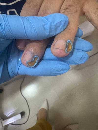 tratamento de verruga tratamento de verruga