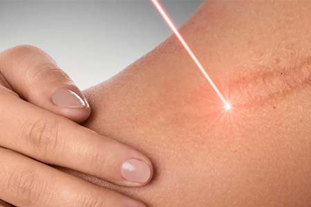 Laserterapia com benefícios comprovados na regeneração tecidual laserterapia com benefícios comprovados na regeneração tecidual