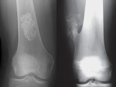 Encondroma e osteocondroma Encondroma e osteocondroma