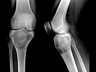Tumor de células gigantes Tumor de células gigantes