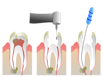 endodontia endodontia